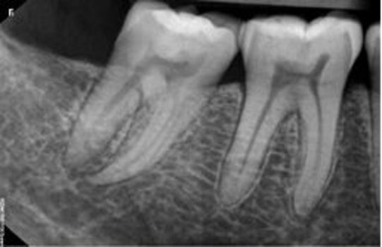 Perfect smile dental clinic digital x-ray bangalore rvg